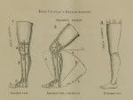Palmer's Patent